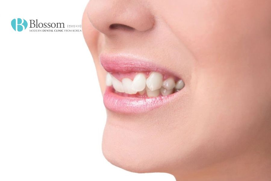 Răng khểnh là vị trí răng nanh mọc bất thường.