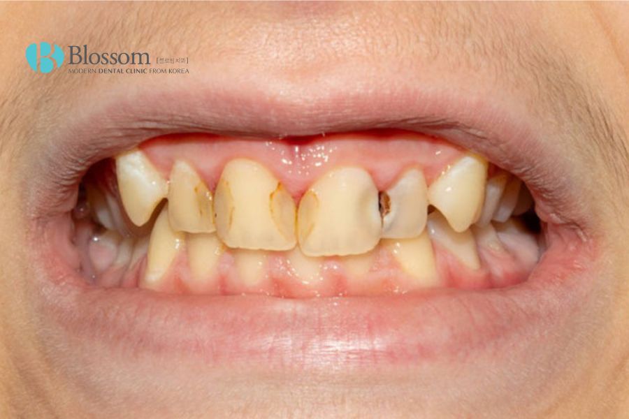 Răng không đều là nguyên nhân gây nên nhiều tình trạng bệnh lý nha khoa khác.
