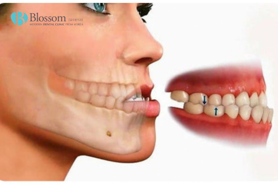 Răng lệch hàm dễ ảnh hưởng đến hệ tiêu hóa khi quá trình ăn nhai bị tác động.