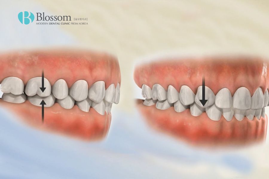 Răng lệch hàm là bệnh lý nha khoa thường gặp.