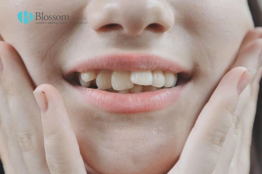 Răng mọc không đều là tình trạng nha khoa thường gặp.