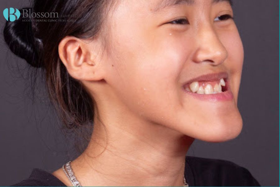 Răng móm, hay còn gọi là khớp cắn ngược, là tình trạng hàm dưới nhô ra trước so với hàm trên.