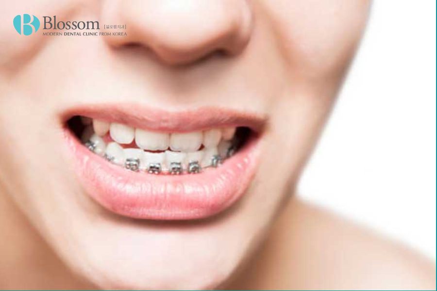 Răng móm khiến cho việc vệ sinh răng miệng trở nên khó khăn hơn.
