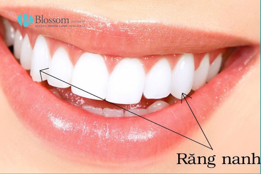 Răng nanh có hình dạng dài, nhọn và mỏng hơn so với các răng khác.