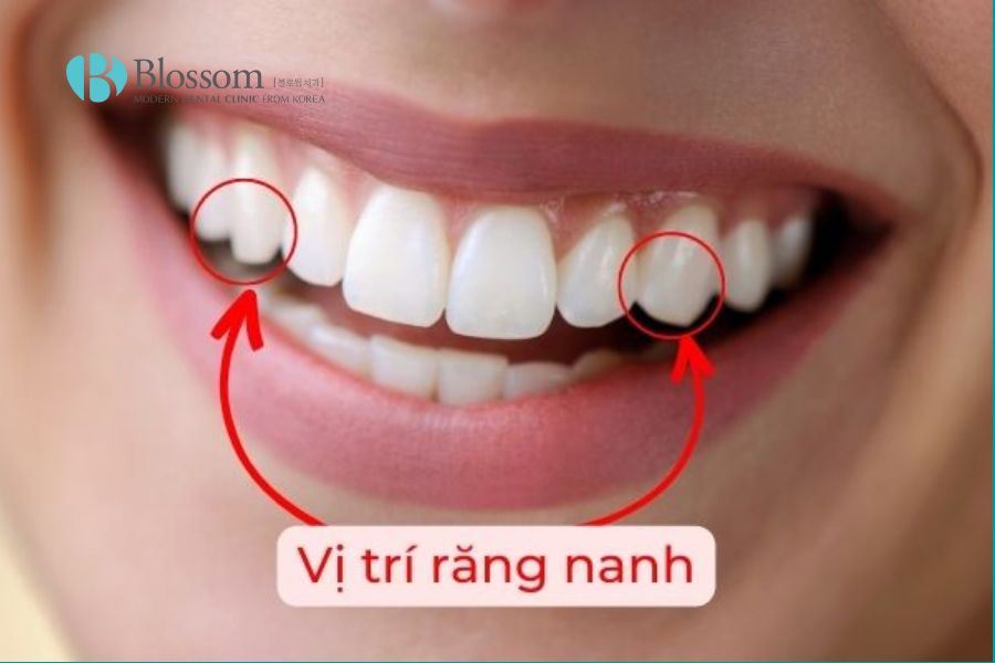 Răng nanh như một bộ giảm chấn động mạnh trong hệ thống nhai của chúng ta.