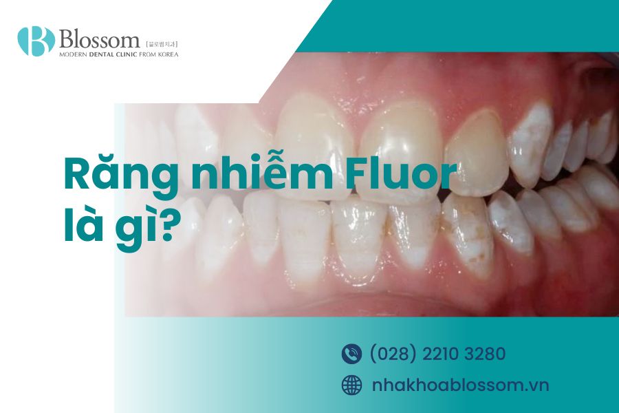 Răng nhiễm Fluor là gì? Cách điều trị như thế nào?