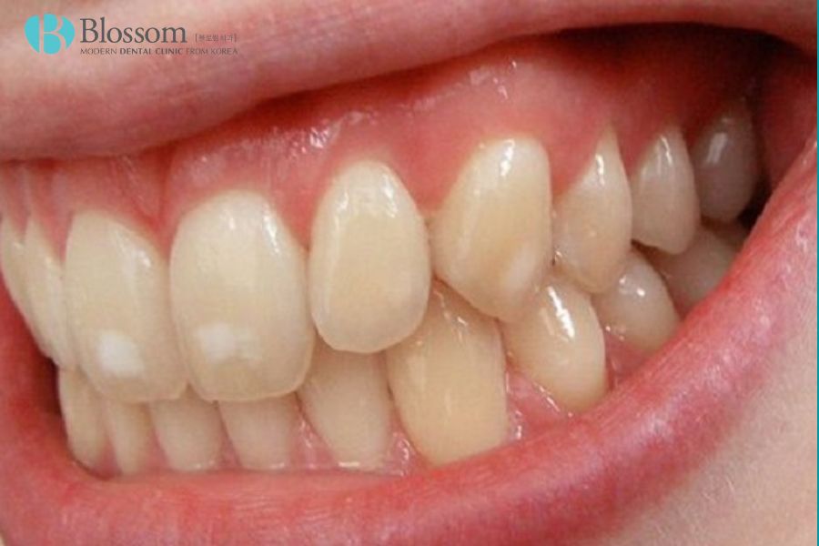 Răng nhiễm fluor là tình trạng răng trở nên xốp, dễ vỡ và có đốm trắng hoặc nâu.