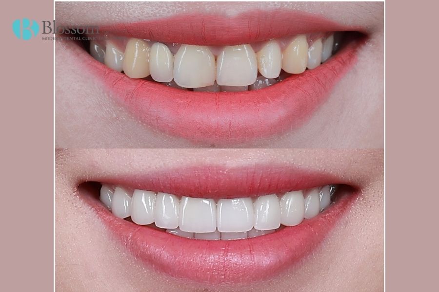 Răng sứ Lamifilm được chế tác độc quyền mang lại vẻ đẹp tinh xảo và nụ cười tự nhiên