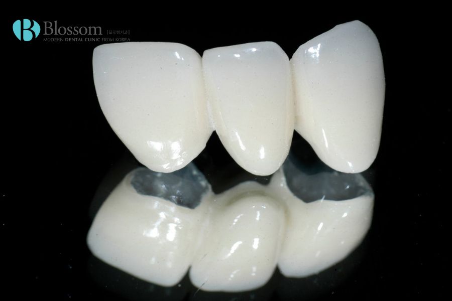 Răng sứ Titan là dòng răng giả được thiết kế với kiểu dáng và màu sắc tương tự răng thật