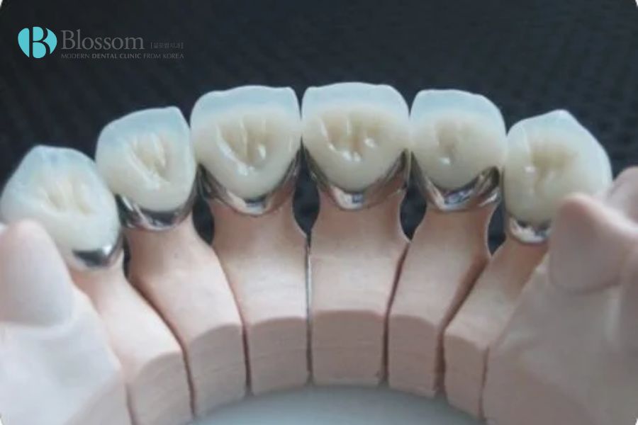 Răng sứ Titan phù hợp với những người có cơ địa nhạy cảm