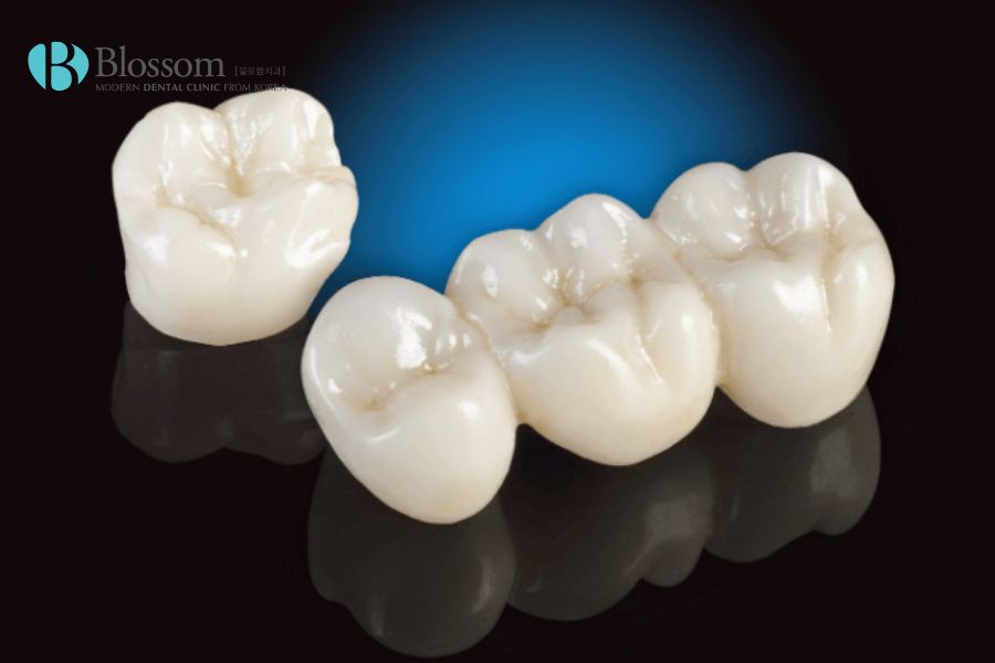 Răng sứ Titan Vita với thiết kế đơn giản, hiệu quả thẩm mỹ cao