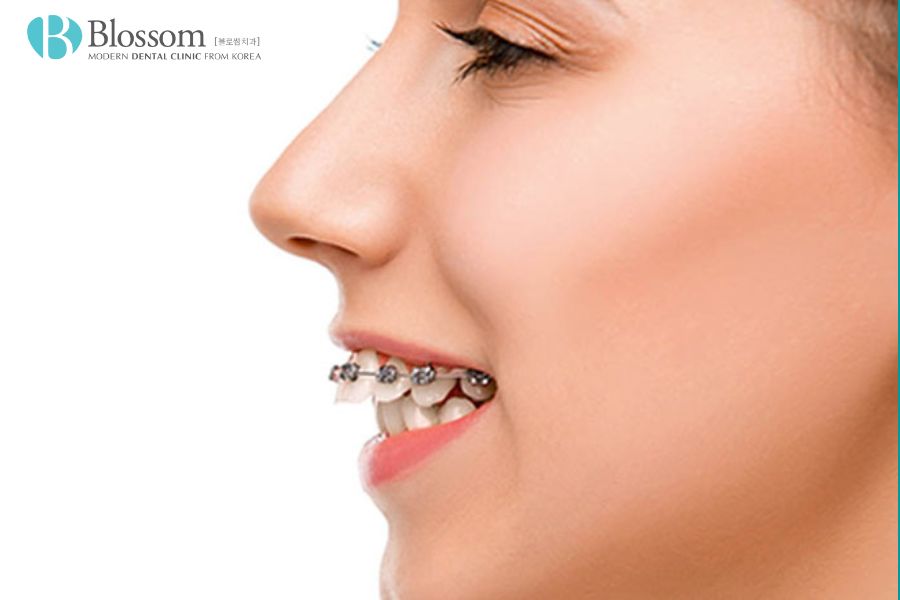 Răng vẩu hàm trên là tình trạng hàm trên nhô ra trước so với hàm dưới.