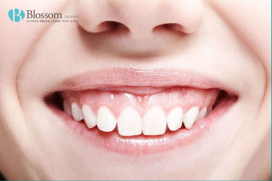 Răng vẩu hở lợi là tình trạng lợi lộ ra quá nhiều khi cười.