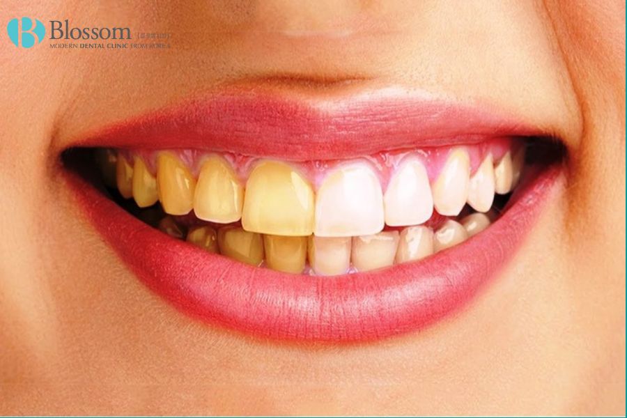 Răng xỉn màu là tình trạng răng không còn trắng sáng tự nhiên mà chuyển sang màu vàng hoặc đen.