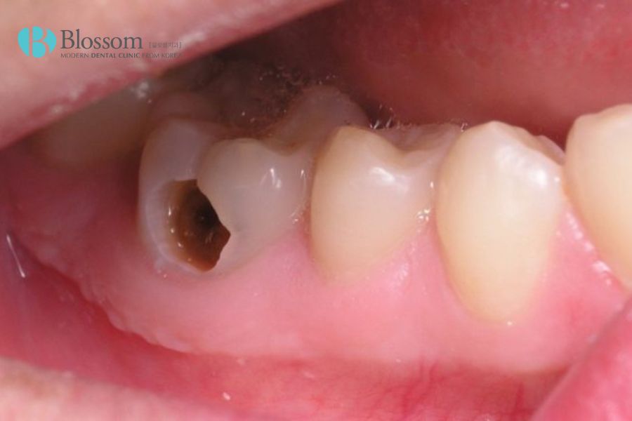 Sâu răng là một trong những nguyên nhân dẫn đến chết tủy răng