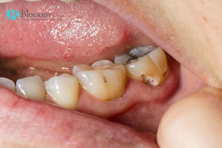 Sâu răng là một trong những nguyên nhân dẫn đến tình trạng mất răng