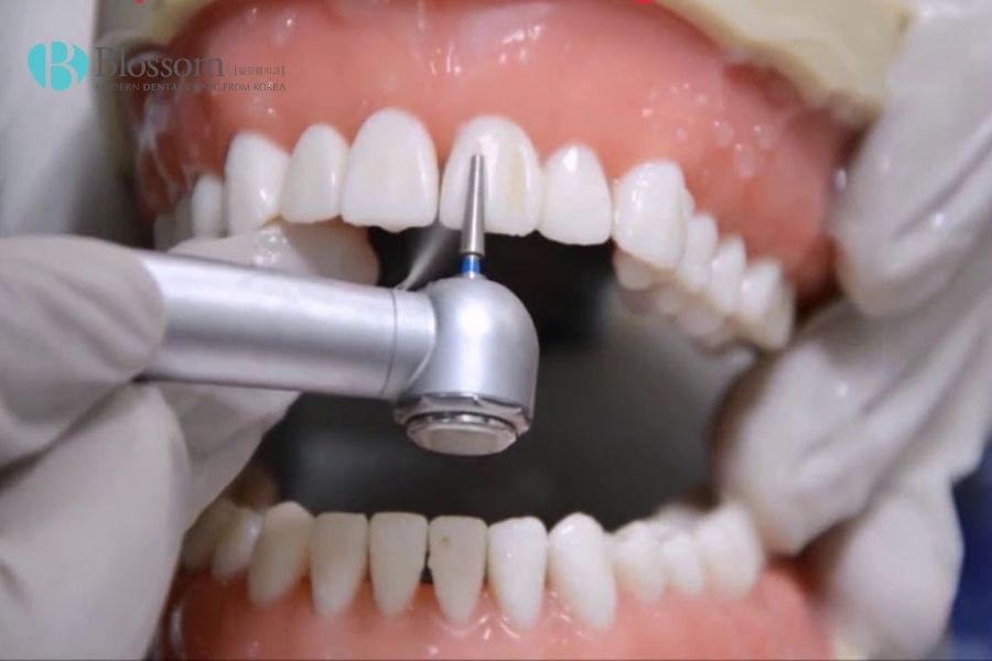 Số lượng răng thực hiện dán sứ cũng ảnh hưởng đến chi phí tổng thể khi thực hiện dán Veneer Emax