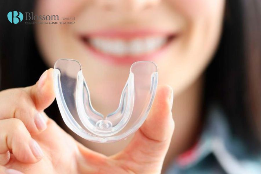 Sử dụng hàm bảo vệ để giảm đau sau khi thực hiện đắp răng sứ