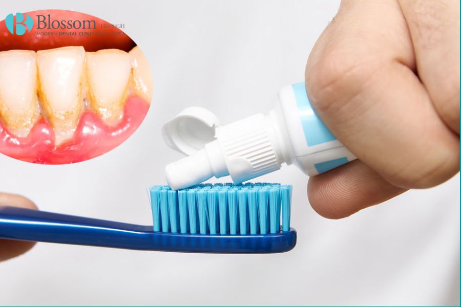 Sử dụng kem đánh răng có chứa chất ngừa cao răng giúp giảm thiểu sự hình thành cao răng.