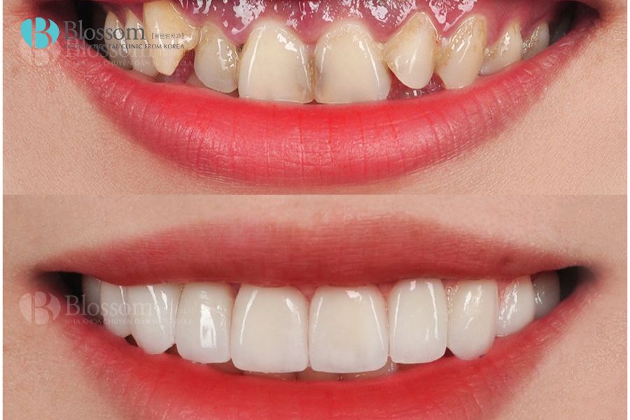 Sự khác biệt tuyệt vời giữa trước và sau khi dán răng sứ.