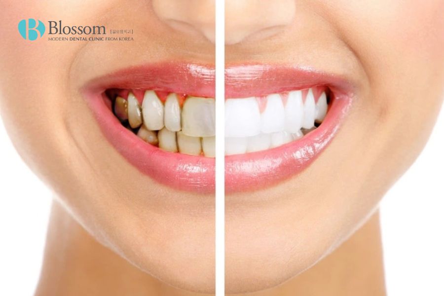 Tẩy trắng răng là biện pháp đơn giản giúp bạn có được nụ cười rạng rỡ.