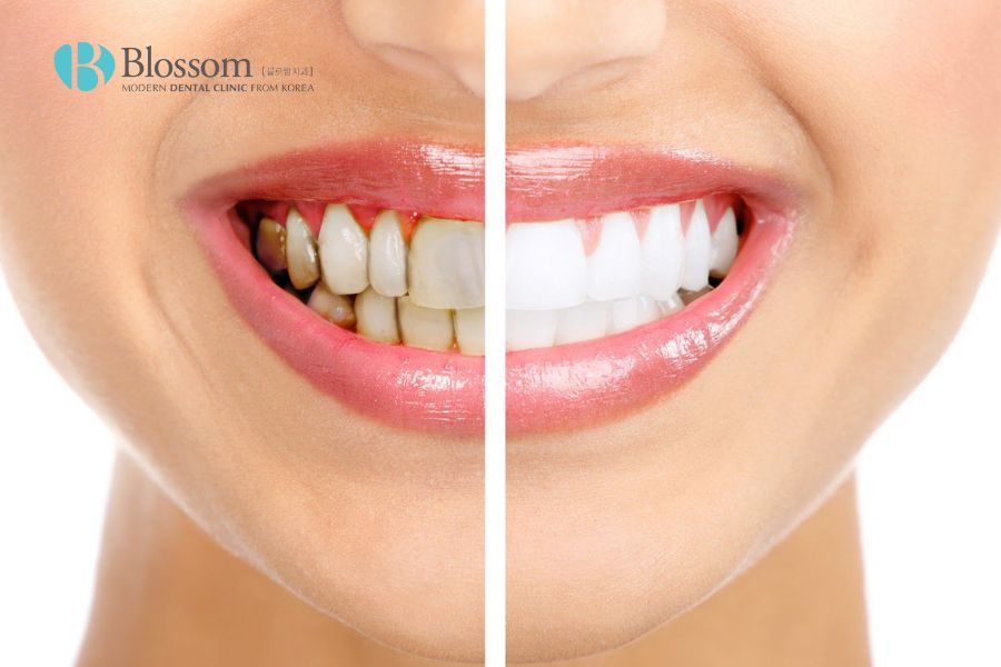 Tẩy trắng răng là phương pháp cải thiện màu sắc răng hiệu quả.