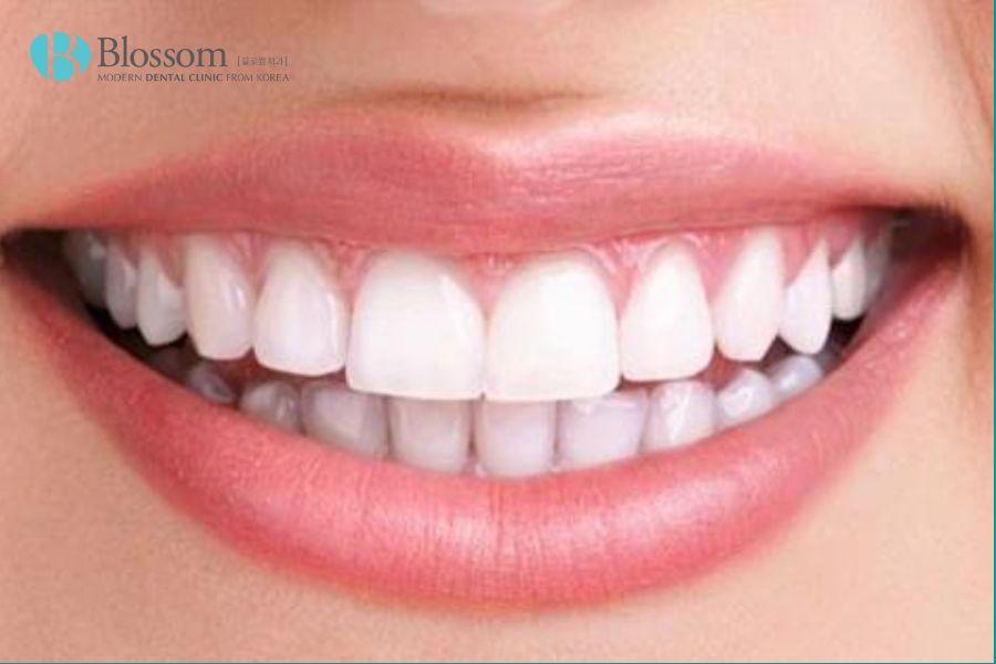 Tẩy trắng răng là phương pháp phổ biến nhất để làm trắng răng.