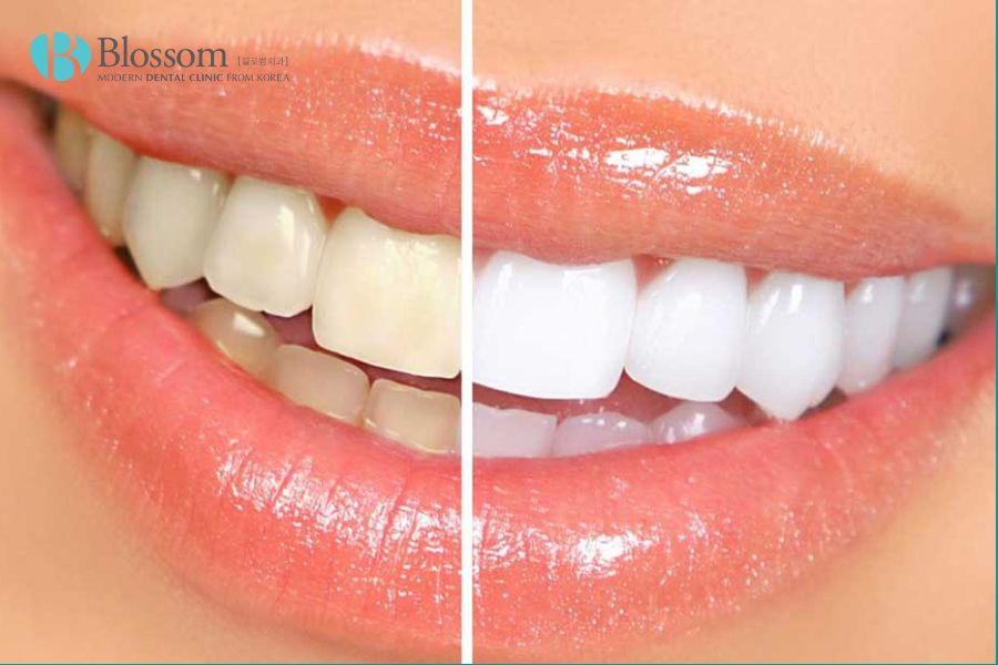 Tẩy trắng răng phù hợp cho những trường hợp răng bị nhiễm fluor nhẹ.