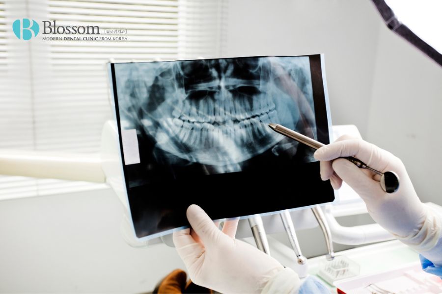 Thăm khám và chụp X-quang tổng quát để xác định mức độ viêm tủy răng