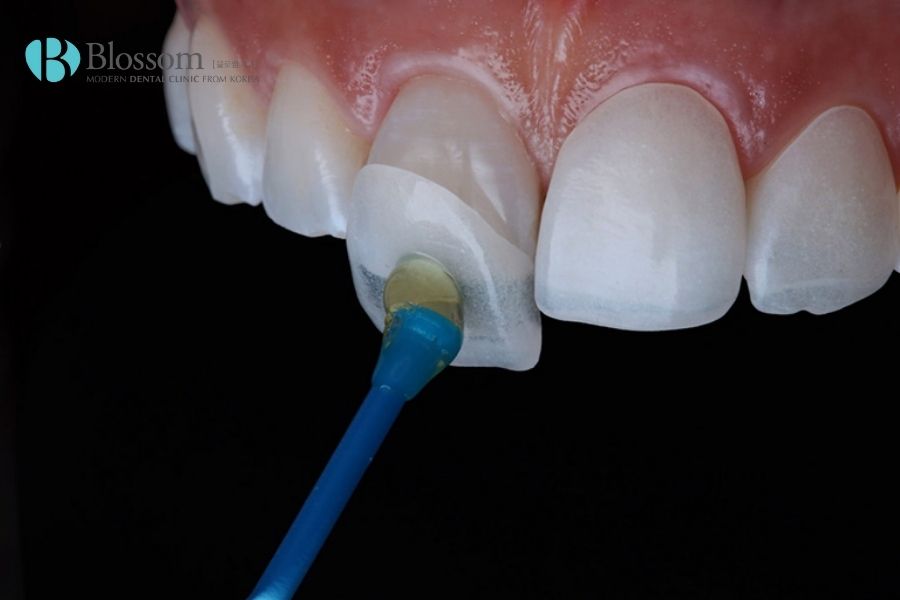 Thực hiện dán mặt sứ Veneer Emax vào răng sao cho khít sát và mang tính thẩm mỹ cao