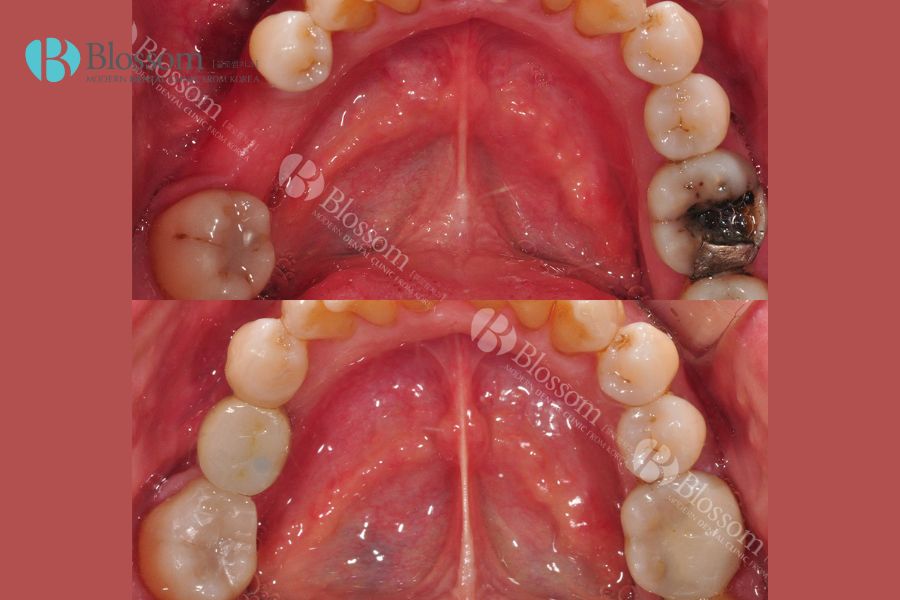 Thực hiện trồng Implant cho răng hàm, cải thiện hiệu quả chức năng ăn nhai