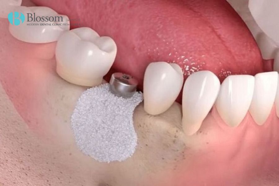 Thực hiện trồng răng Implant để ngăn ngừa tốt nhất tình trạng tiêu xương hàm