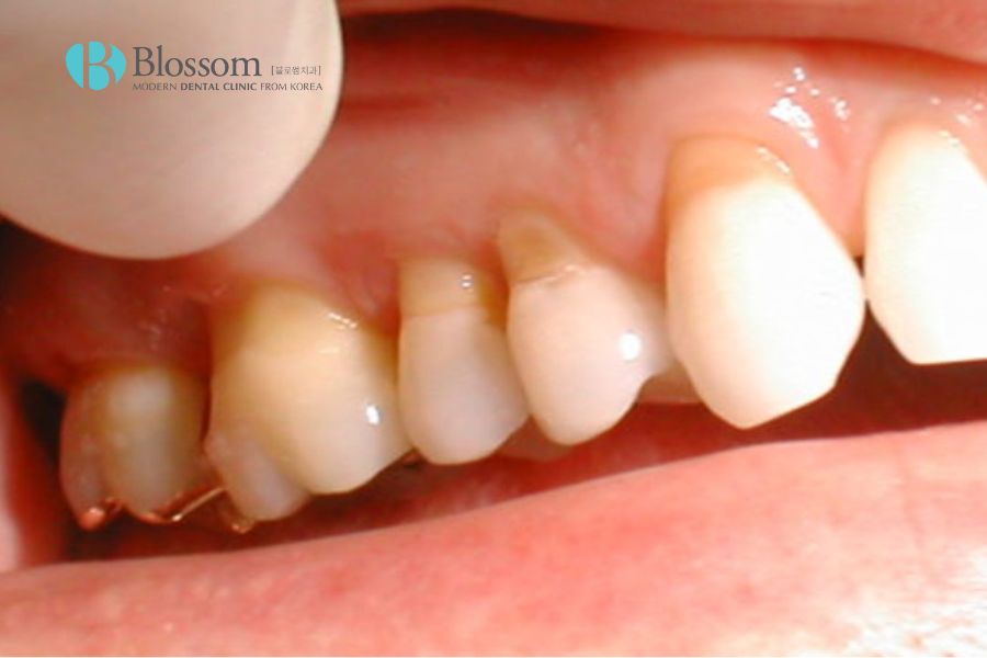 Tình trạng mòn men răng khiến răng trở nên đau nhức, nhạy cảm và ê buốt hơn.
