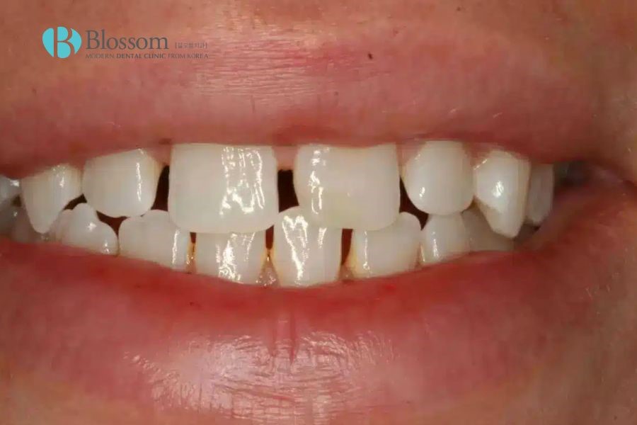 Tình trạng răng bị thưa rất phổ biến trong nha khoa
