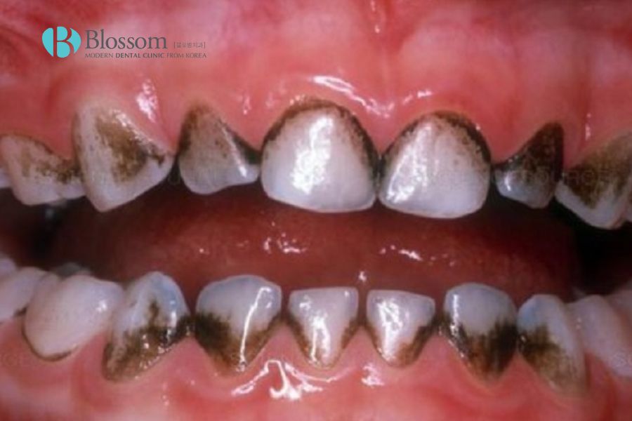 Tình trạng răng bị xỉn đen gây mất thẩm mỹ rất lớn cho nụ cười.