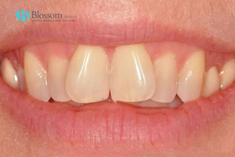 Tình trạng răng bị xô lệch rất thường gặp trong nha khoa.
