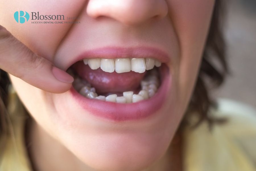 Tình trạng răng mọc không đều khiến nhiều người e ngại, mất tự tin trong giao tiếp.