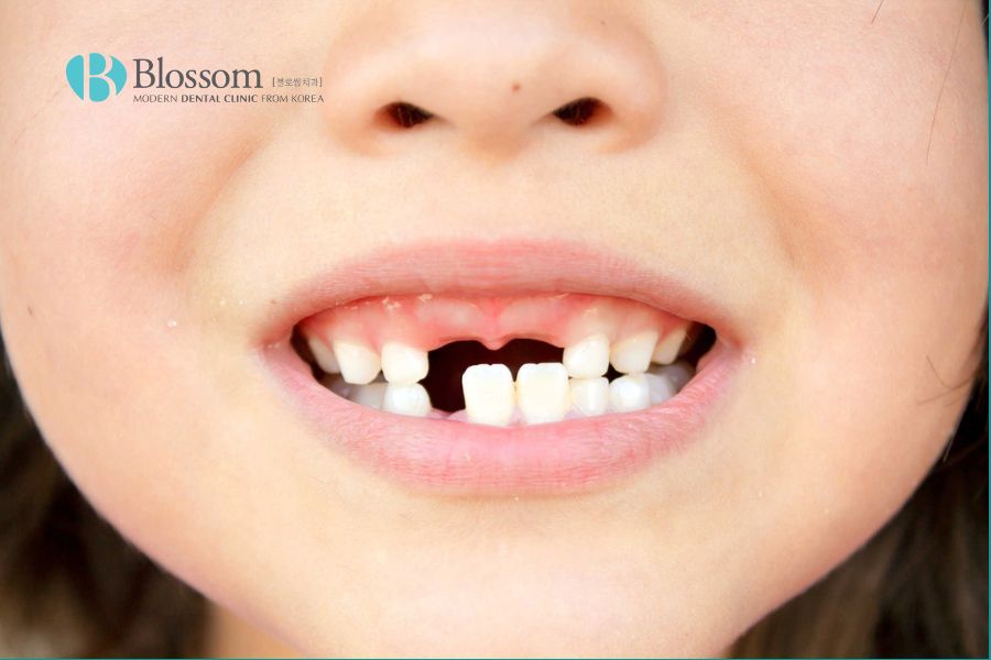 Trẻ em dưới 18 tuổi xương hàm chưa phát triển hoàn toàn nên chưa phù hợp trồng răng vĩnh viễn