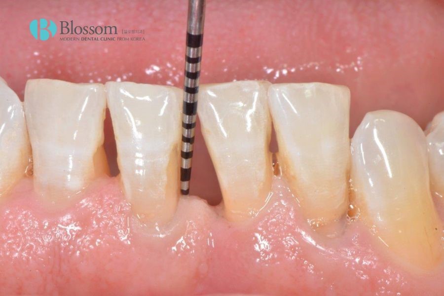 Trong nhiều trường hợp, răng có xu hướng dịch chuyển rời xa nhau sẽ dẫn tới răng thưa.