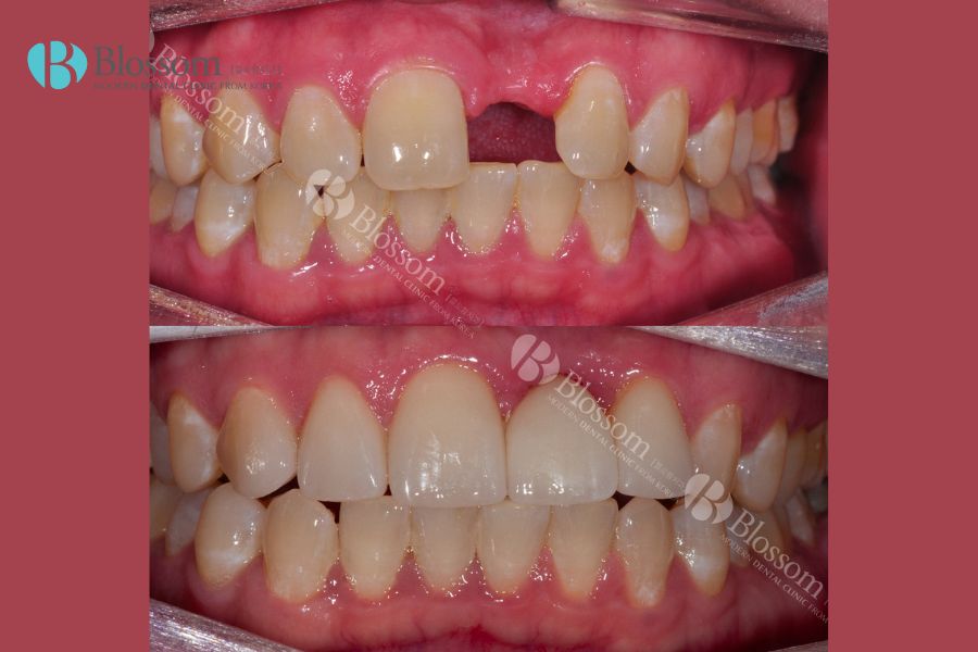 Trồng răng giả cố định bằng phương pháp cấy ghép Implant cho răng cửa