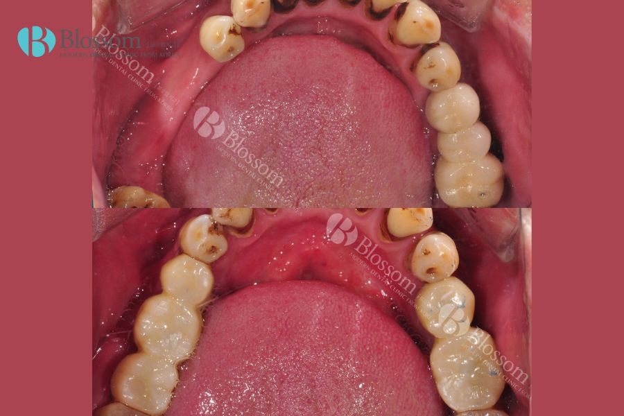 Trồng răng giả cố định Implant uy tín, an toàn tại Nha Khoa Blossom
