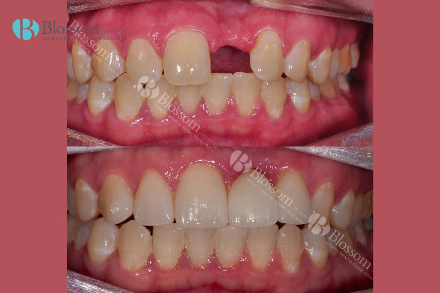 Trồng răng giả uy tín tại Nha Khoa Blossom với phương pháp cấy ghép Implant an toàn