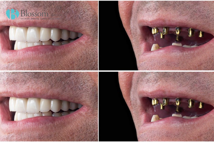 Trồng răng Implant cho người lớn tuổi an toàn tại Nha Khoa Blossom