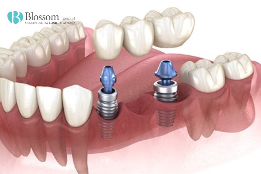 Trồng răng Implant có chi phí về lâu dài sẽ tiết kiệm hơn so với răng giả tháo lắp