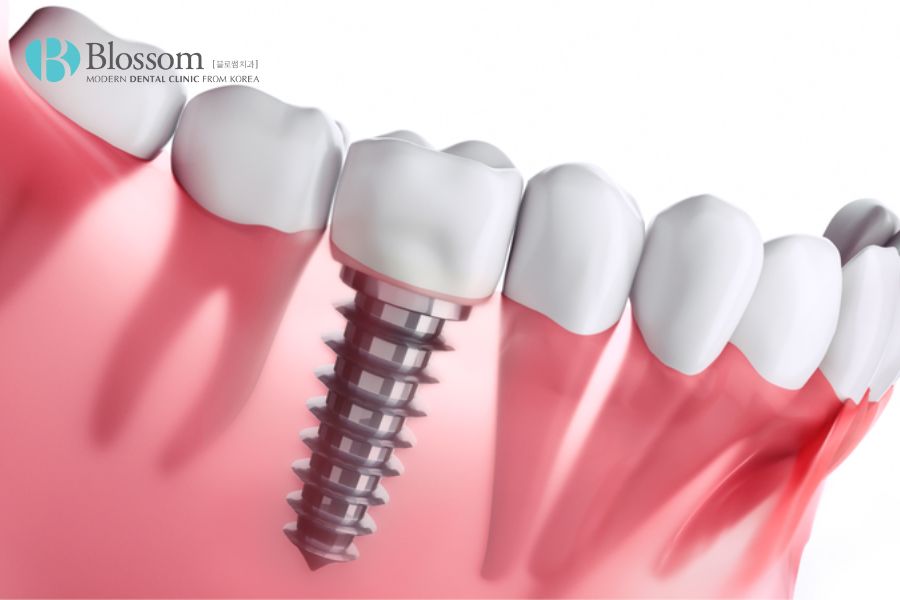 Trồng răng Implant có độ bền vượt trội và thẩm mỹ hoàn hảo