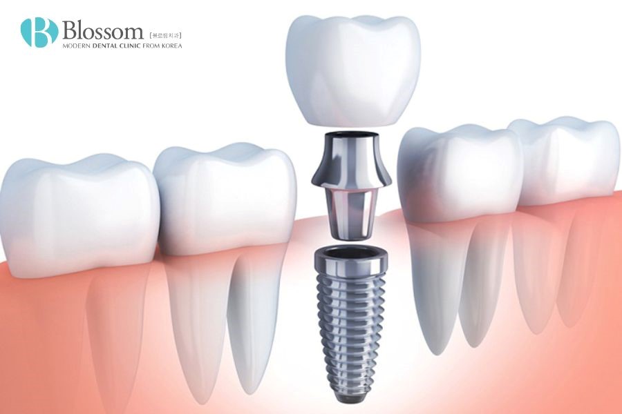Trồng răng Implant giúp giải quyết trình trạng răng thưa do mất răng