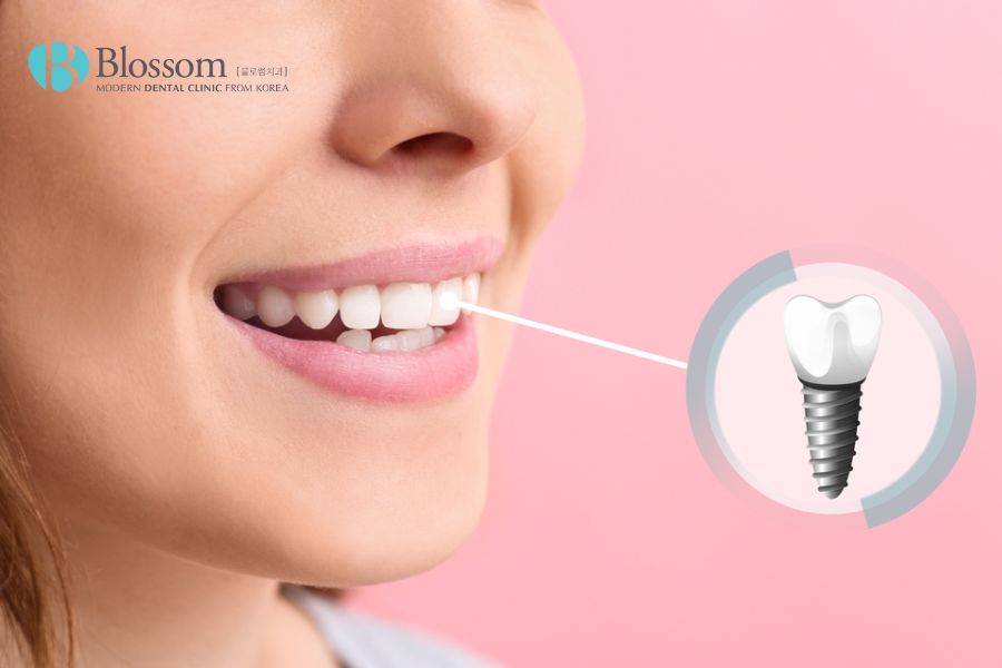 Trồng răng Implant hỗ trợ bảo toàn các răng lân cận