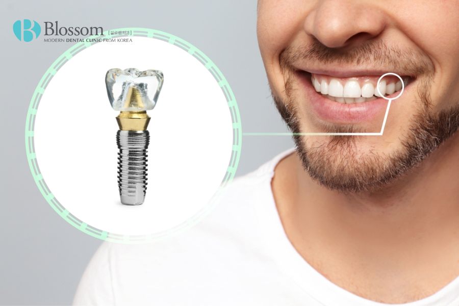 Trồng răng Implant là giải pháp tối ưu có thể thay thế hàm răng giả tháo lắp