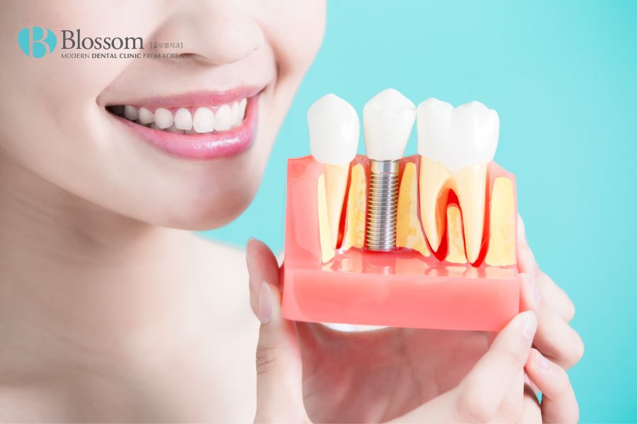 Trồng răng Implant mang lại độ thẩm mỹ cao, sở hữu nụ cười rạng ngời
