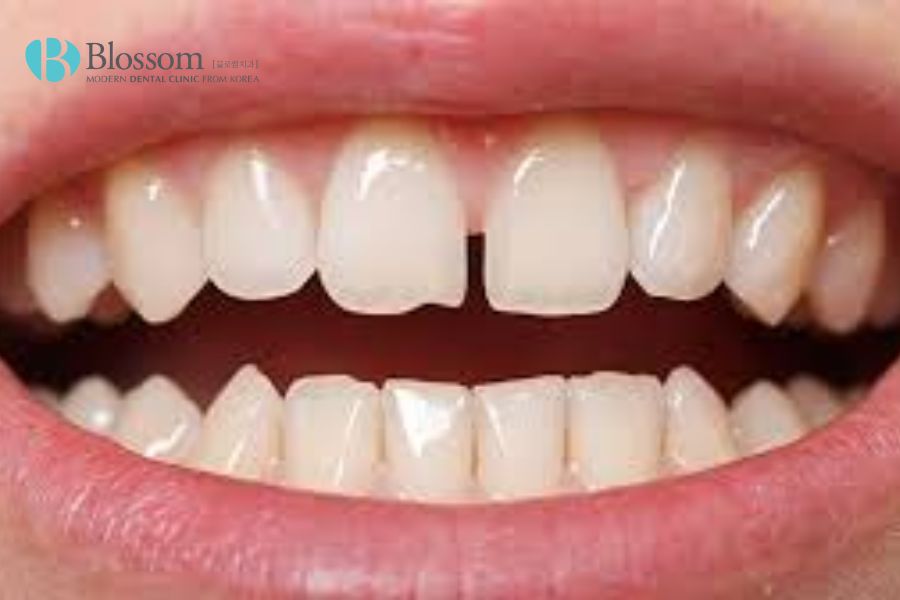 Trồng răng sứ giúp giải quyết vấn đề răng bị thưa hở nhanh chóng